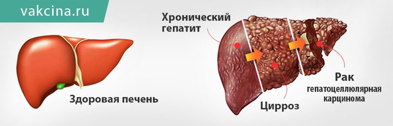 Осложнения гепатита B