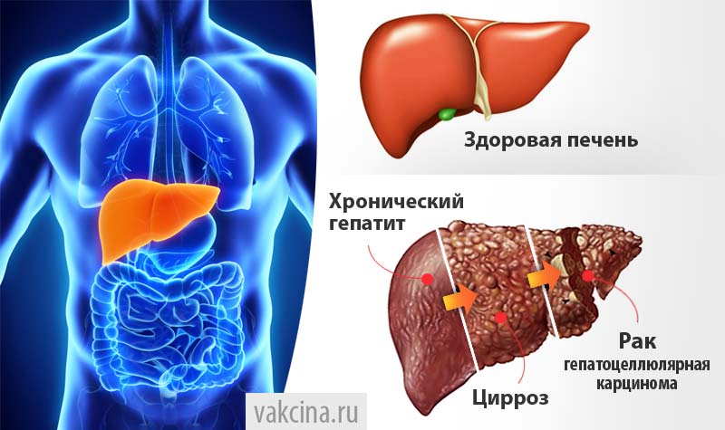 Вирусные гепатиты - последствия заболевания
