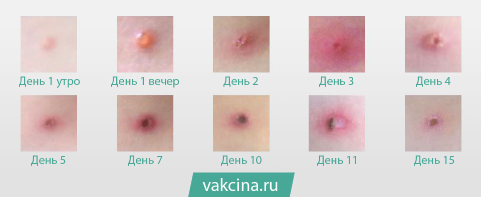 Стадии высыпаний ветряной оспы