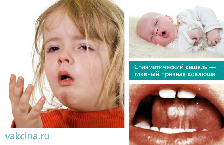 Признаки коклюша
