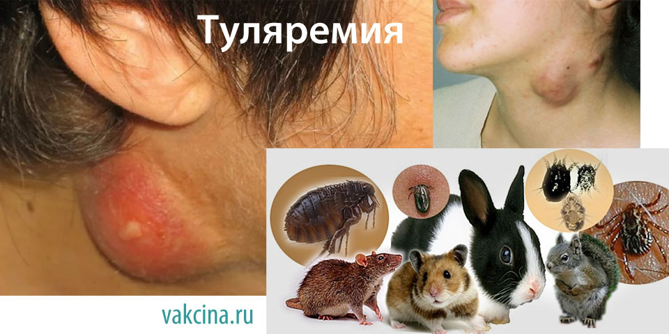Туляремия