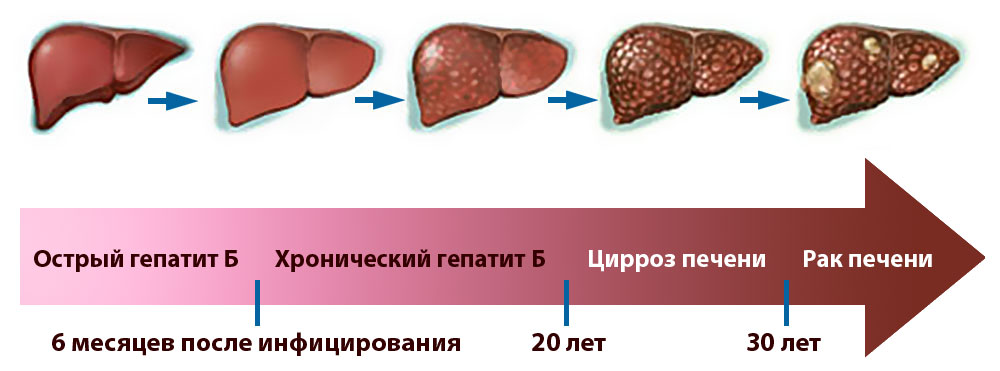 Гепатит Б - от инфицирования к раку
